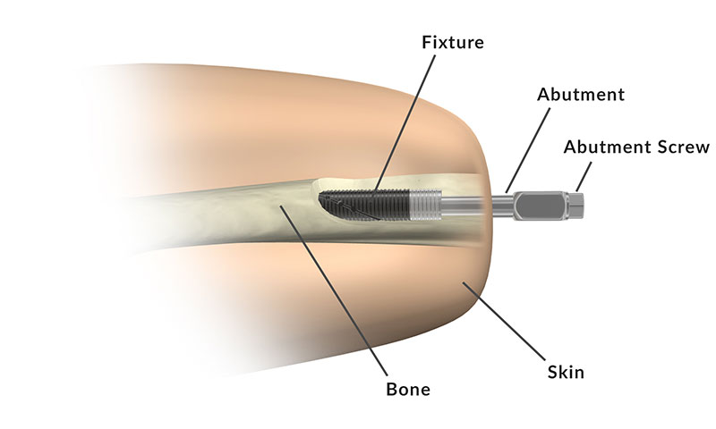 Osseointegration