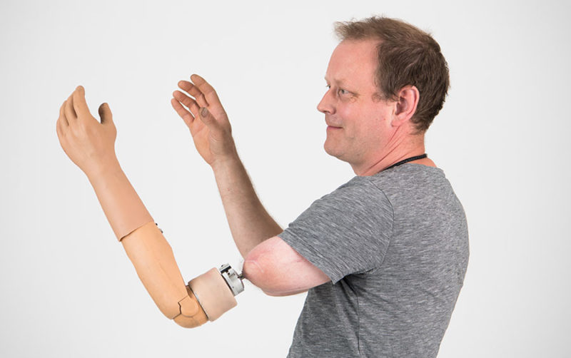 Osseointegration patient reaching out his hands.