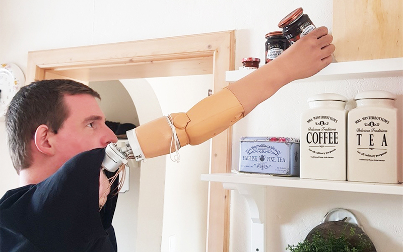 Man with bone-anchored above elbow prosthesis reaching